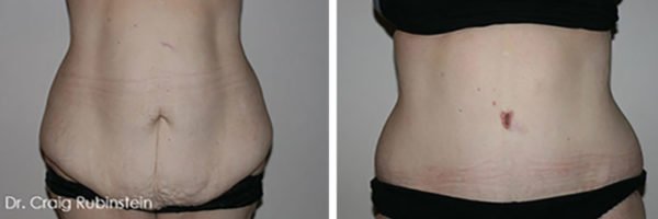 tummy-tuck-recovery-surgery-1