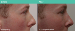 rhinoplasty-dr-stephen-kleid-19