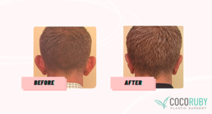 Coco Ruby Plastic Surgery Blog Will Medicare Cover my Ear Surgery Before and After Ear Surgery Image