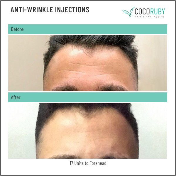 anti-wrinkle-injections-before-and-after-17