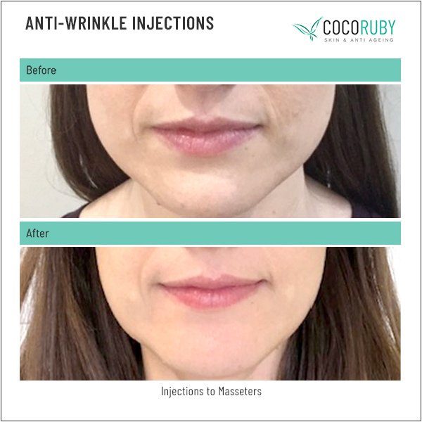 anti-wrinkle-injections-before-and-after-43