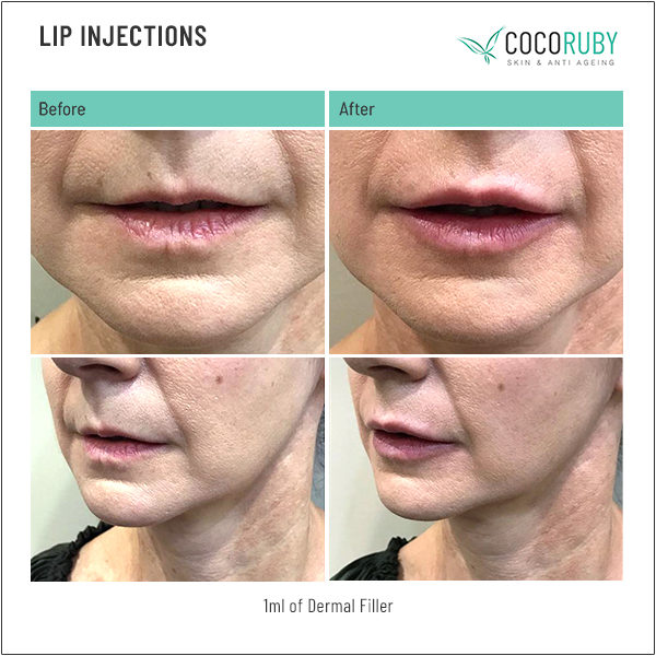 lip-injections-before-and-after-31